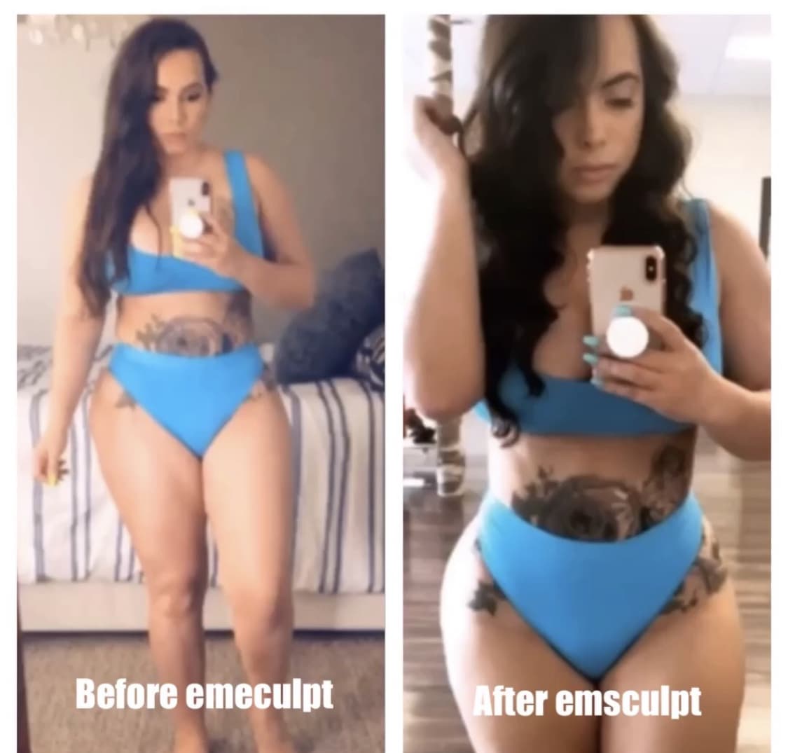 emsculpt before and after chicago